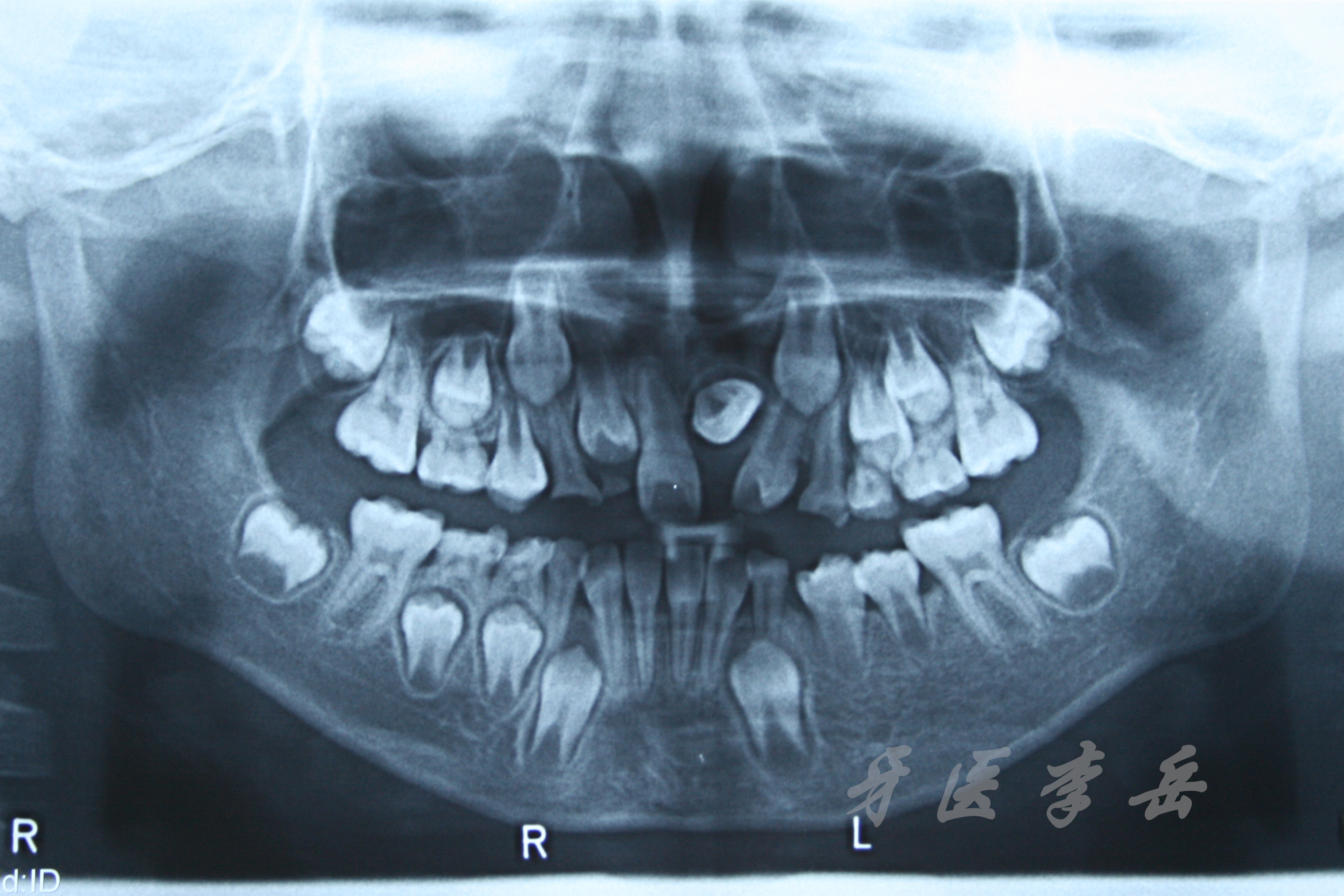 倒置弯根埋伏阻生牙牵出愈后----埋伏牙的治疗 (原创)