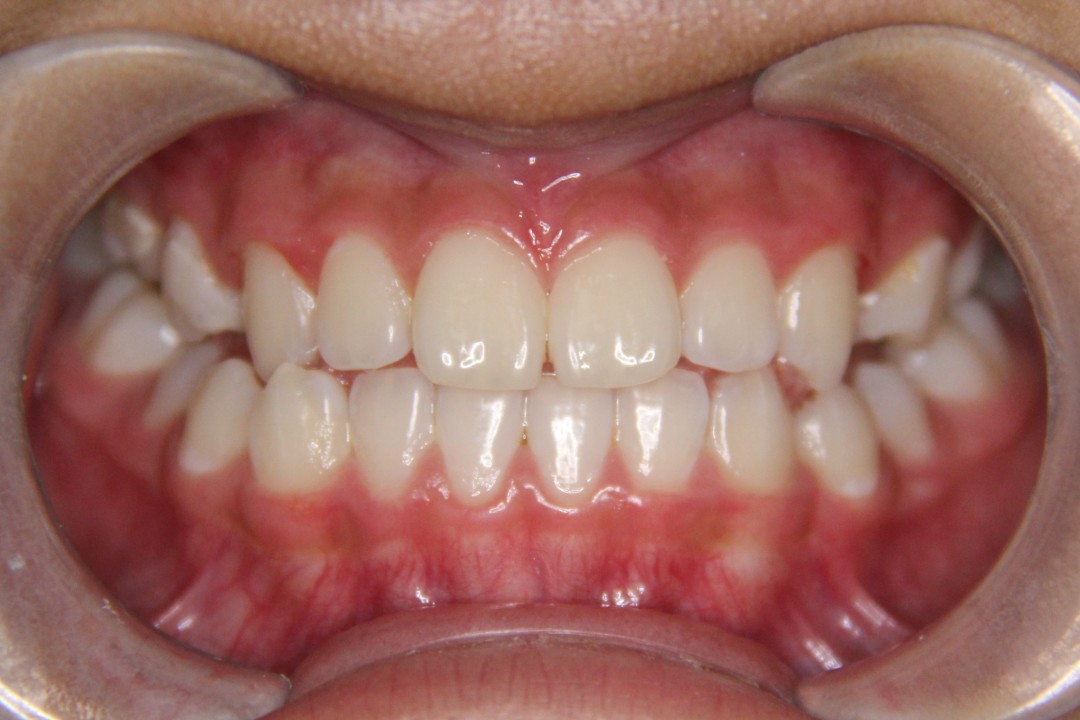 颊侧多曲簧矫治早期反颌病例-----早期兜齿的治疗 - 好大夫在线