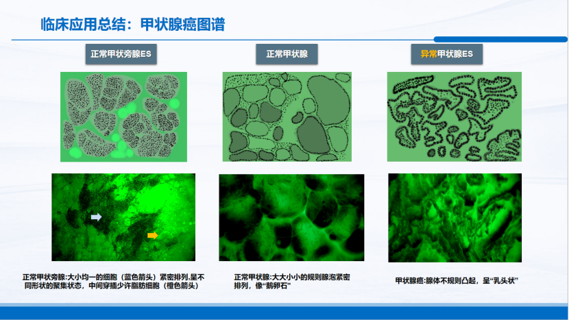 河北甲状腺乳腺微创腔镜盛会：细胞级荧光导引技术EndoSCell®引领甲状腺癌精准手术新浪潮(图5)