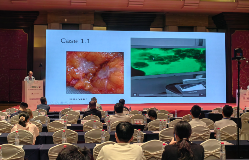 细胞级荧光导引技术亮相第二届赣南苏区乳腺肿瘤学术会议：EndoSCell®实现乳腺癌手术微米级精准切缘(图5)