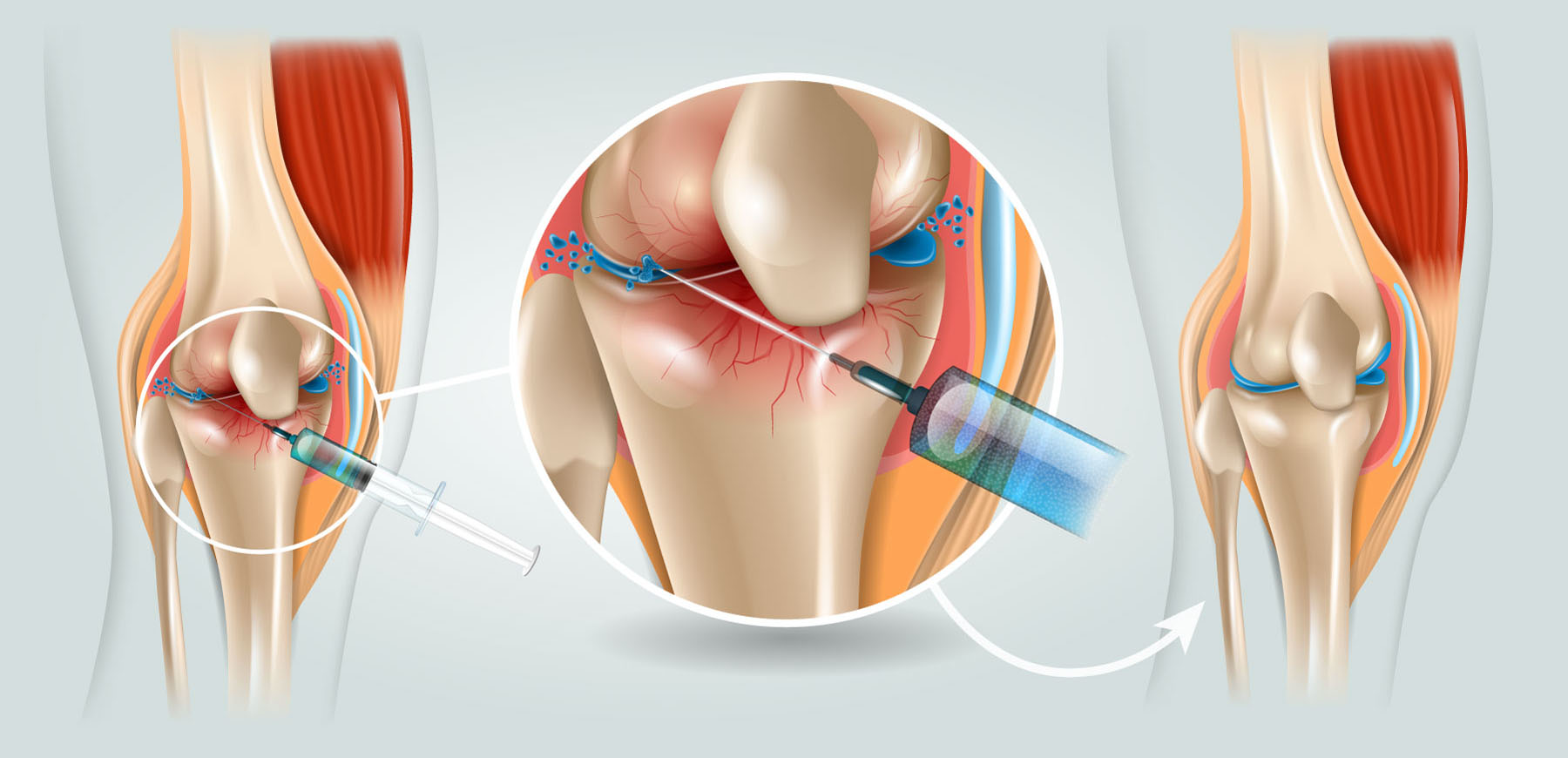 【典型病历】专家亲诊膝关节前交叉韧带损伤重建术后康复