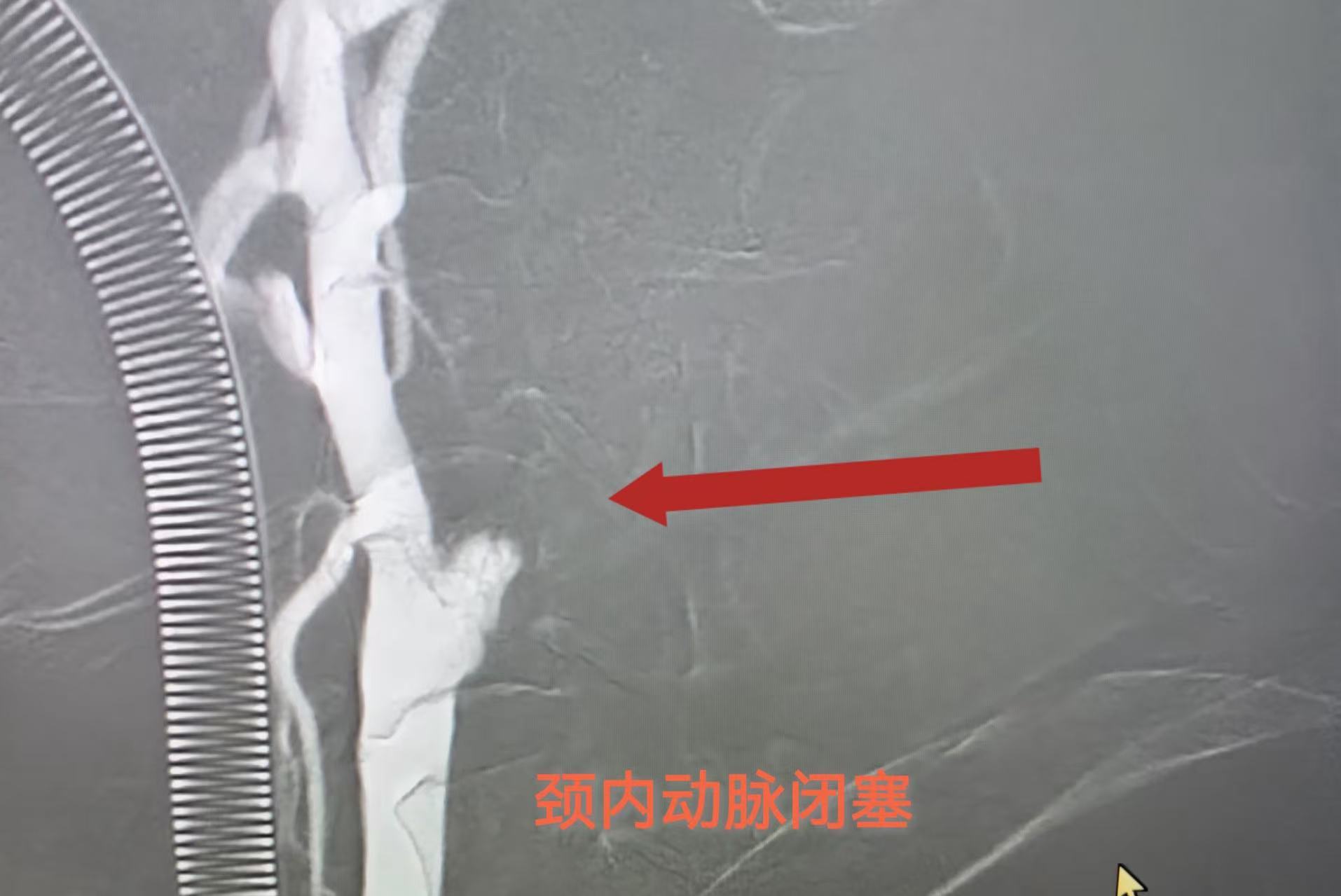 康盈技术 | 我院成功抢救颈内动脉闭塞危重患者(图5)