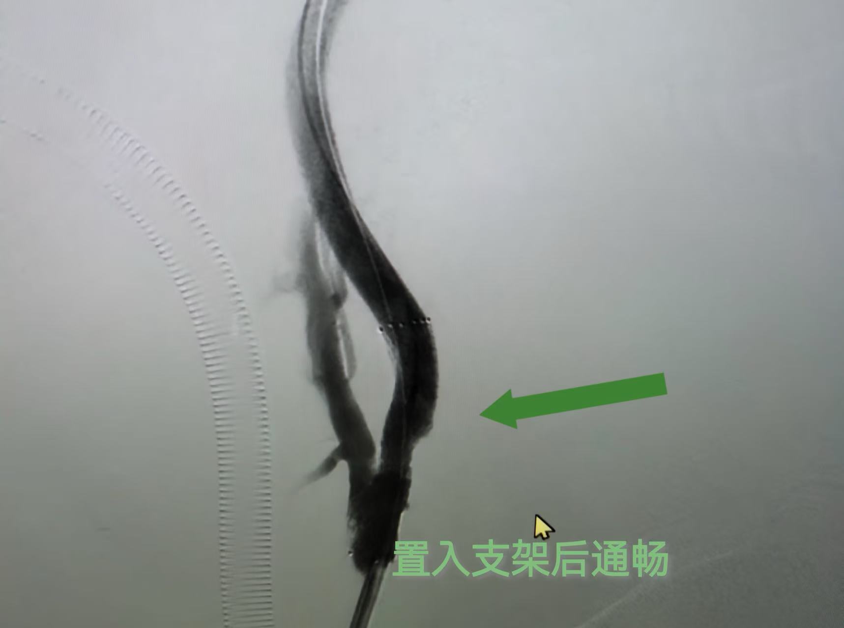 康盈技术 | 我院成功抢救颈内动脉闭塞危重患者(图7)