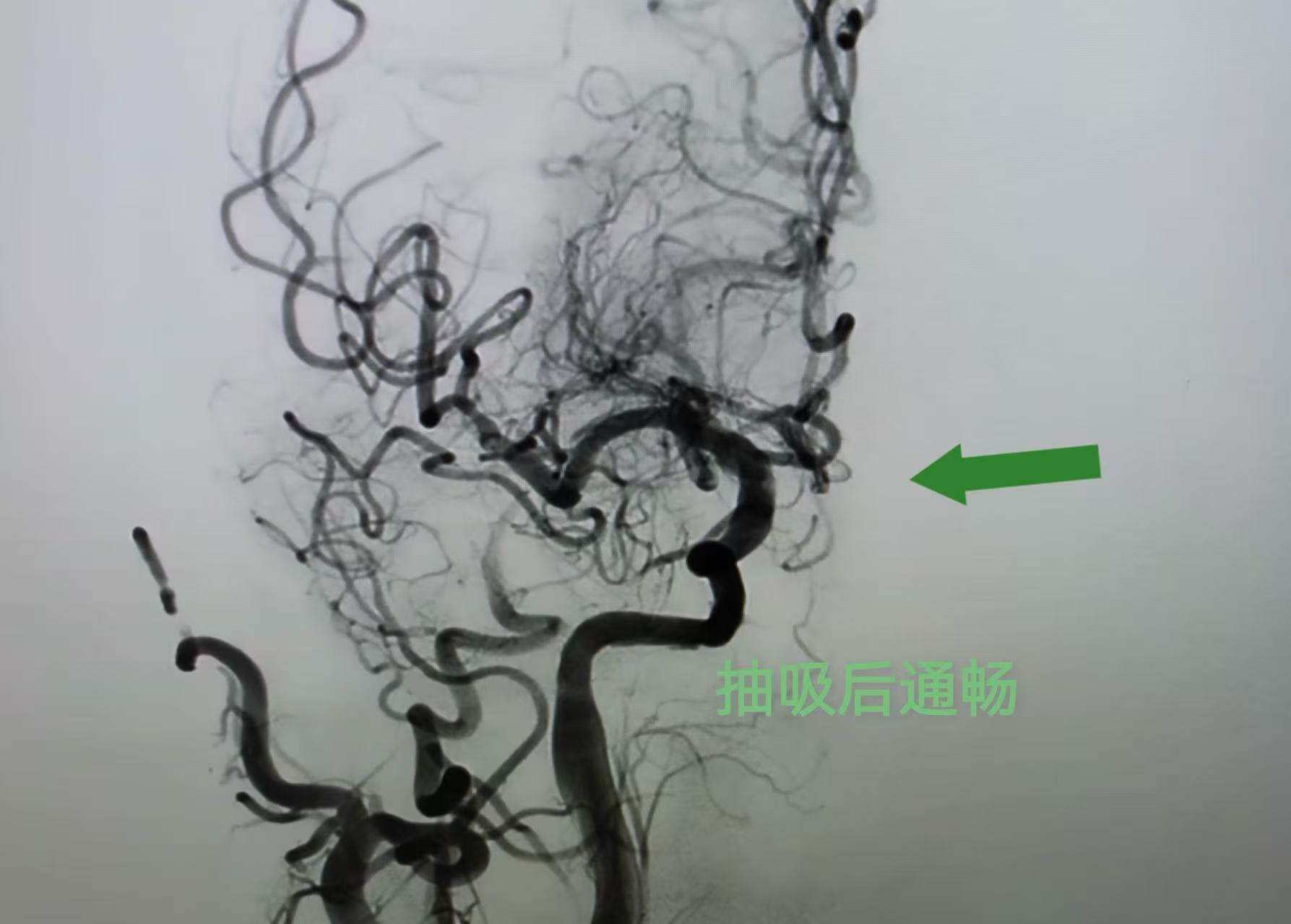 康盈技术 | 我院成功抢救颈内动脉闭塞危重患者(图8)