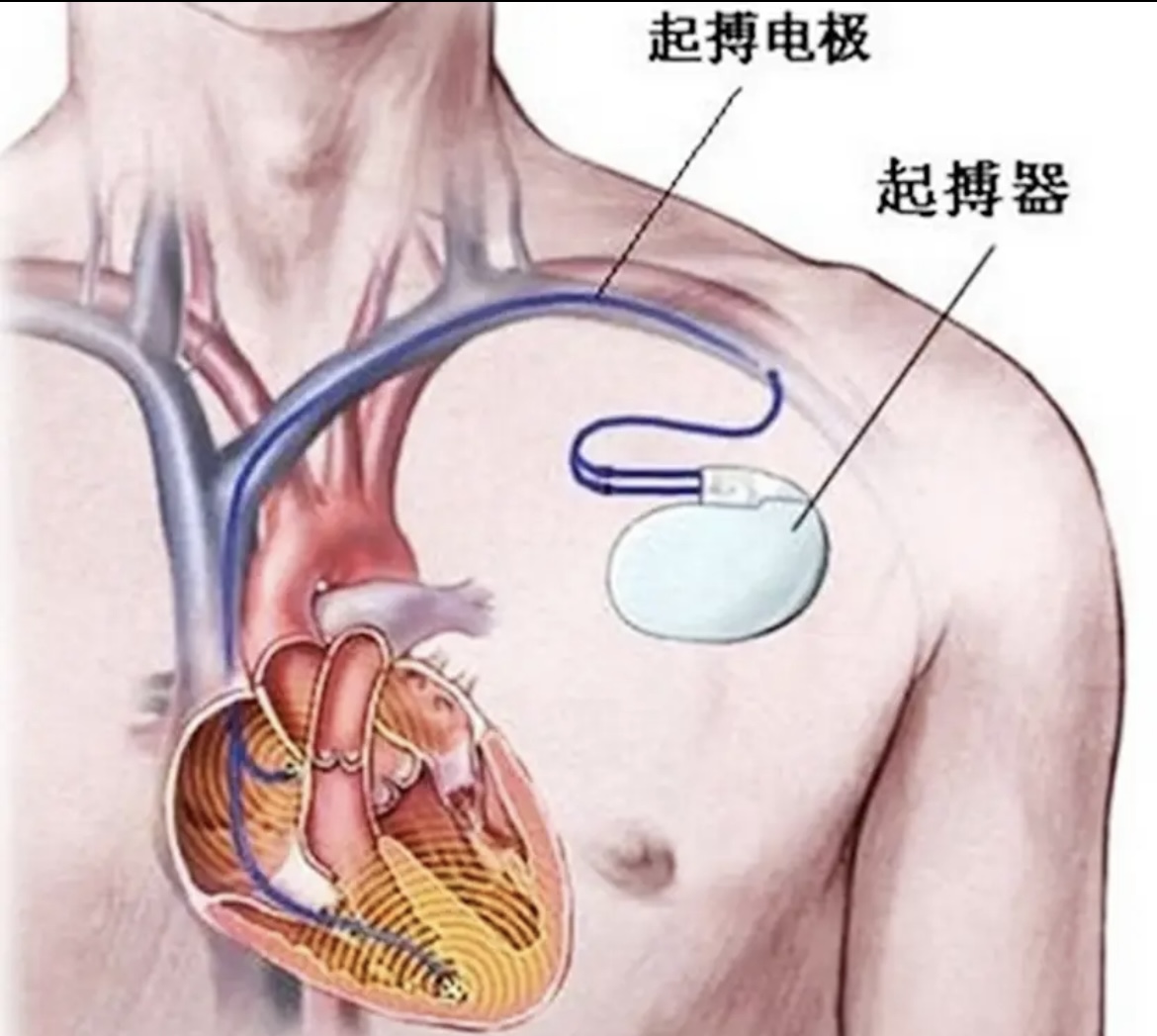 康盈技术 | 我院成功开展首例“心脏永久起搏器植入术”(图12) 康盈技术 | 我院成功开展首例“心脏永久起搏器植入术”(图12)