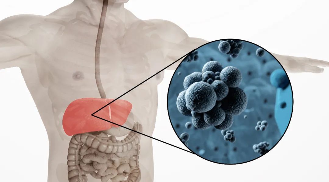 肝癌主要危险因素正发生变化！仪健建议这4类高危人群尝试富氢水(图8)